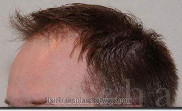 Hair restoration procedure results