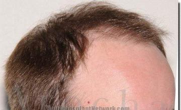 Hair restoration procedure results