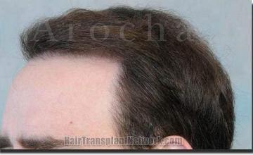 Hair restoration procedure results