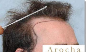 Hair restoration procedure results