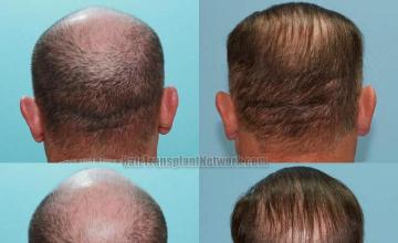 Hair transplantation procedure before and after photo results