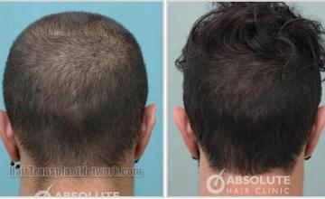 Hair transplantation procedure before and after photo results