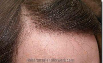 Hair restoration procedure results