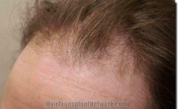 Hair restoration procedure results