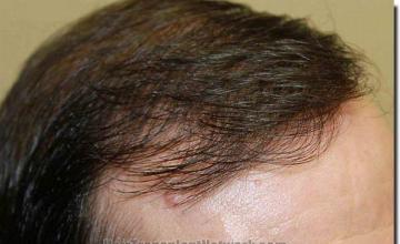 Hair restoration procedure results