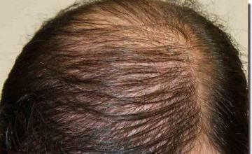 Hair restoration procedure results