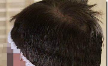 Hair restoration procedure results