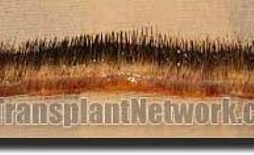 Hair restoration procedure results