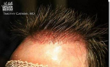 Hair restoration procedure results