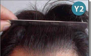 Hair restoration procedure results