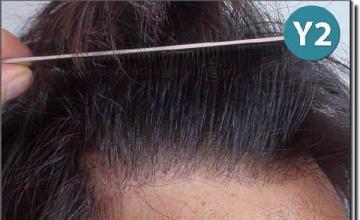 Hair restoration procedure results