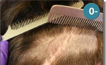 Hair restoration procedure results