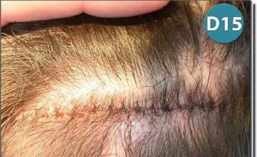 Hair restoration procedure results