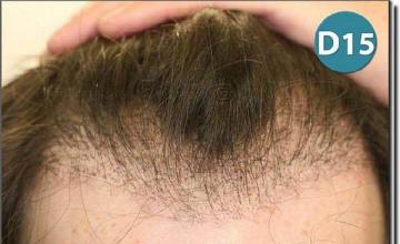 Hair restoration procedure results