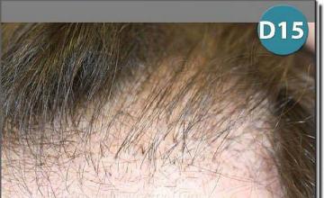 Hair restoration procedure results