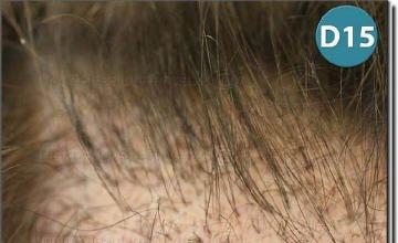 Hair restoration procedure results