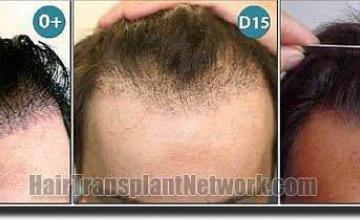 Hair restoration procedure results