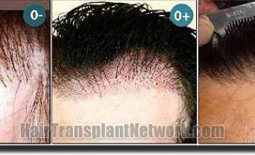 Hair restoration procedure results