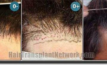 Hair restoration procedure results