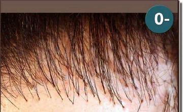 Hair restoration procedure results