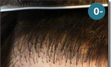 Hair restoration procedure results