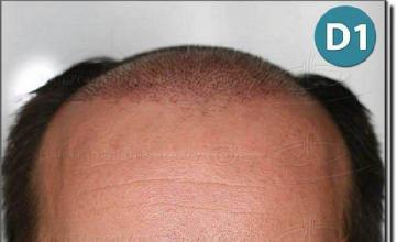 Hair restoration procedure results