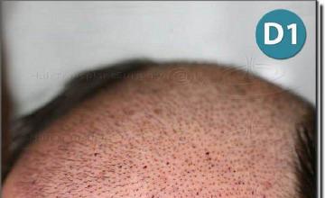 Hair restoration procedure results