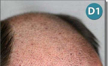 Hair restoration procedure results