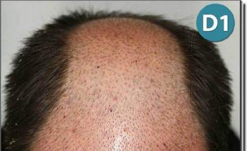 Hair restoration procedure results