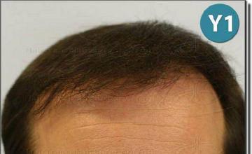 Hair restoration procedure results