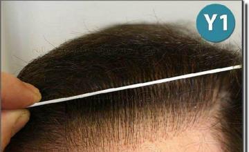 Hair restoration procedure results