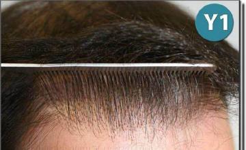 Hair restoration procedure results