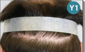Hair restoration procedure results
