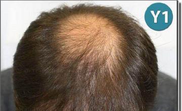 Hair restoration procedure results