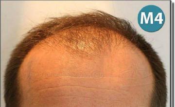 Hair restoration procedure results
