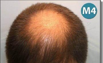 Hair restoration procedure results