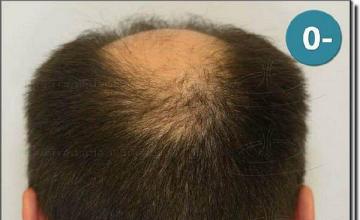 Hair restoration procedure results