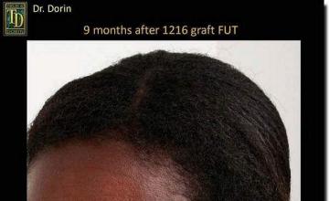 Hair restoration procedure results