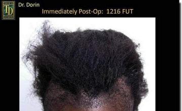 Hair restoration procedure results