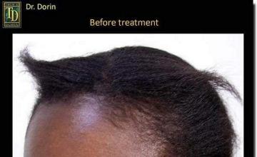 Hair restoration procedure results