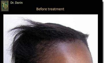 Hair restoration procedure results