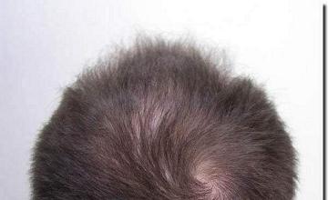 Hair restoration procedure results