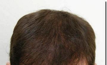 Hair restoration procedure results