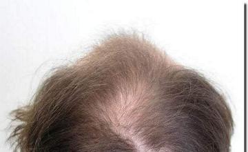 Hair restoration procedure results