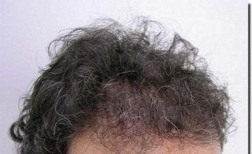 Hair restoration procedure results