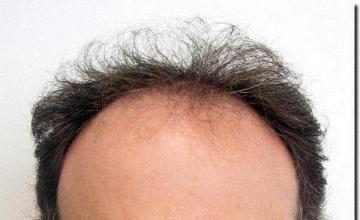 Hair restoration procedure results