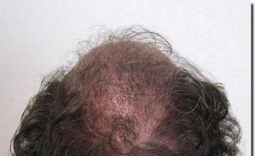 Hair restoration procedure results