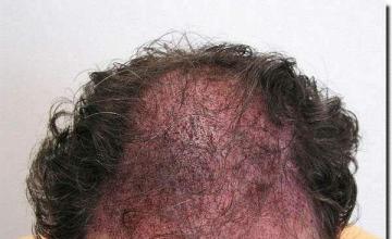 Hair restoration procedure results