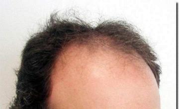 Hair restoration procedure results