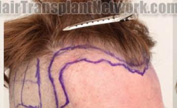 Hair transplantation procedure before and after results